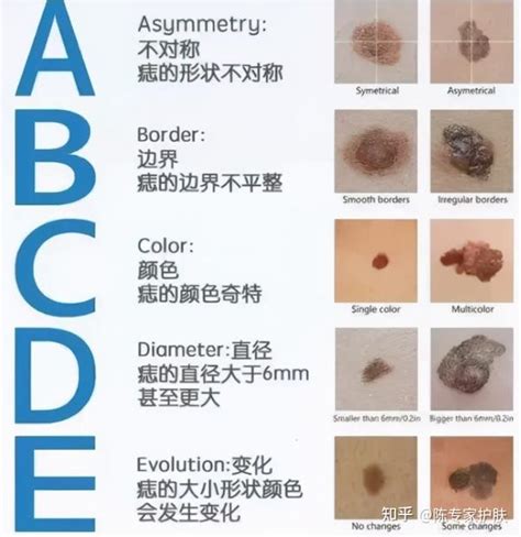 好痣顏色|痣有4種顏色，出現在「手腳這邊」的痣可能是皮膚。